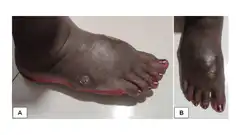 Plantar wart diagnosis imaging