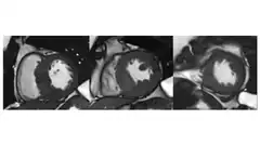Heart MRI and bullseye plots