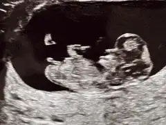 Laser hits fetus in ultrasound