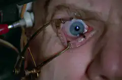 Close-up of an eye with a metal device